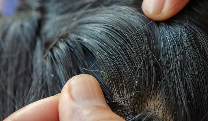 Nissen kleben am Haar Nissen kleben an den Haaren und Kopfhaut